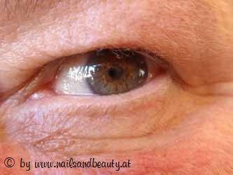 Schlupflieder Vorher